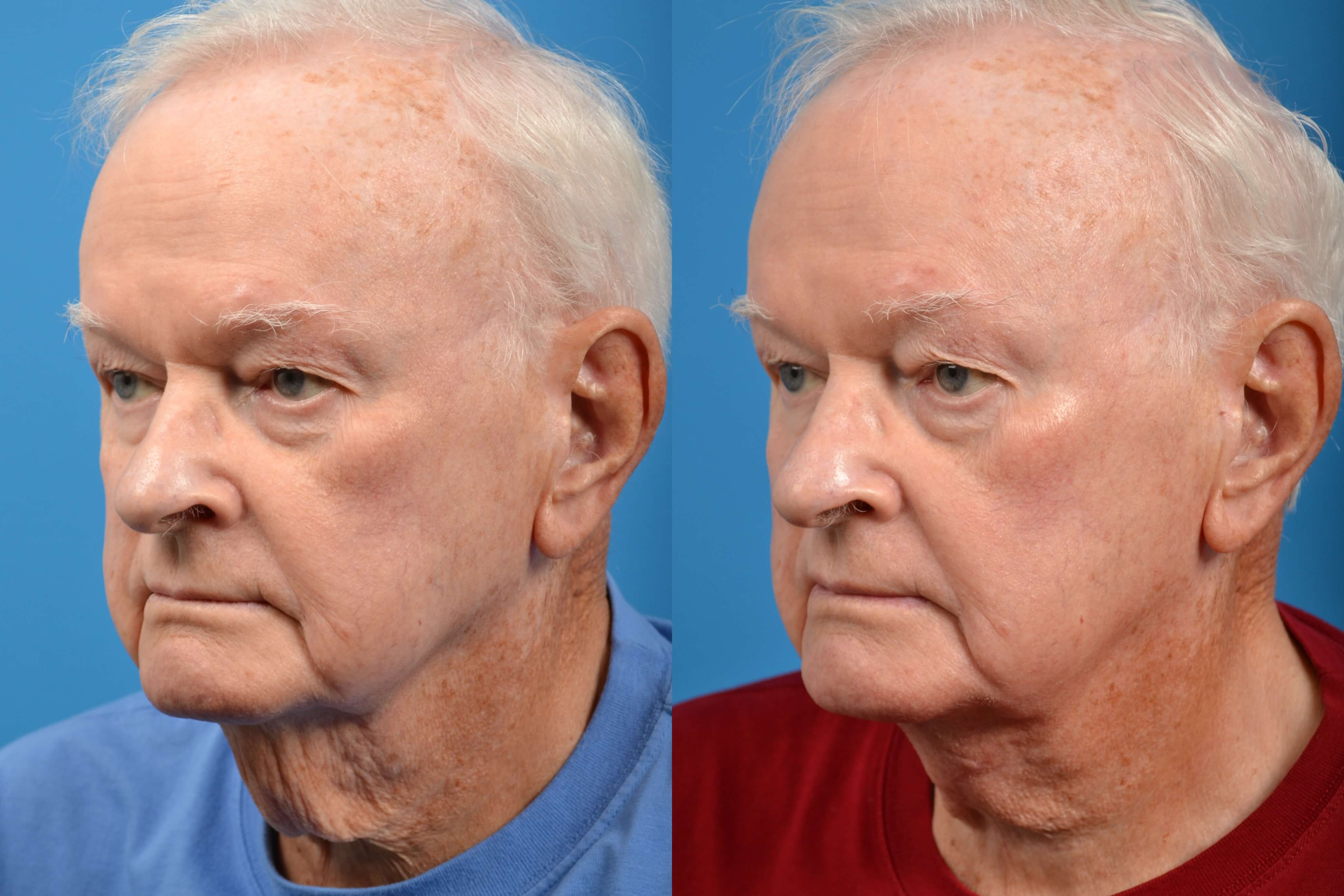 men neck lift        
        <figure class=